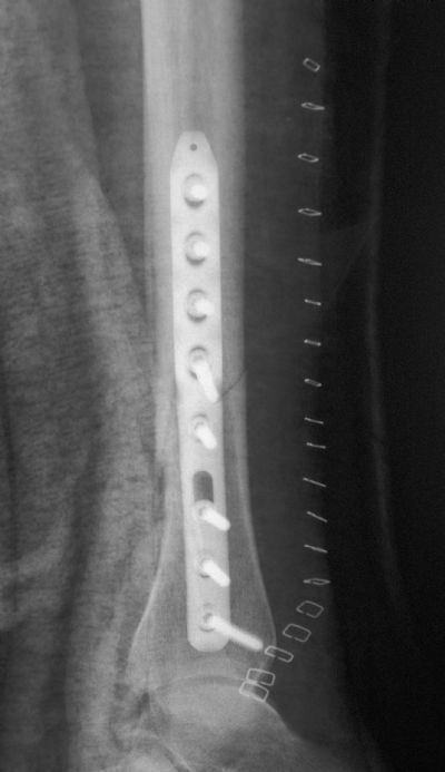 Tibia, Shaft:  Synthes Distal Tibial Plate (Implant 232)